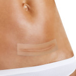 Силиконовый лист для лечения рубцов, 2 размера, Fresco (Испания) 10 х 10 см